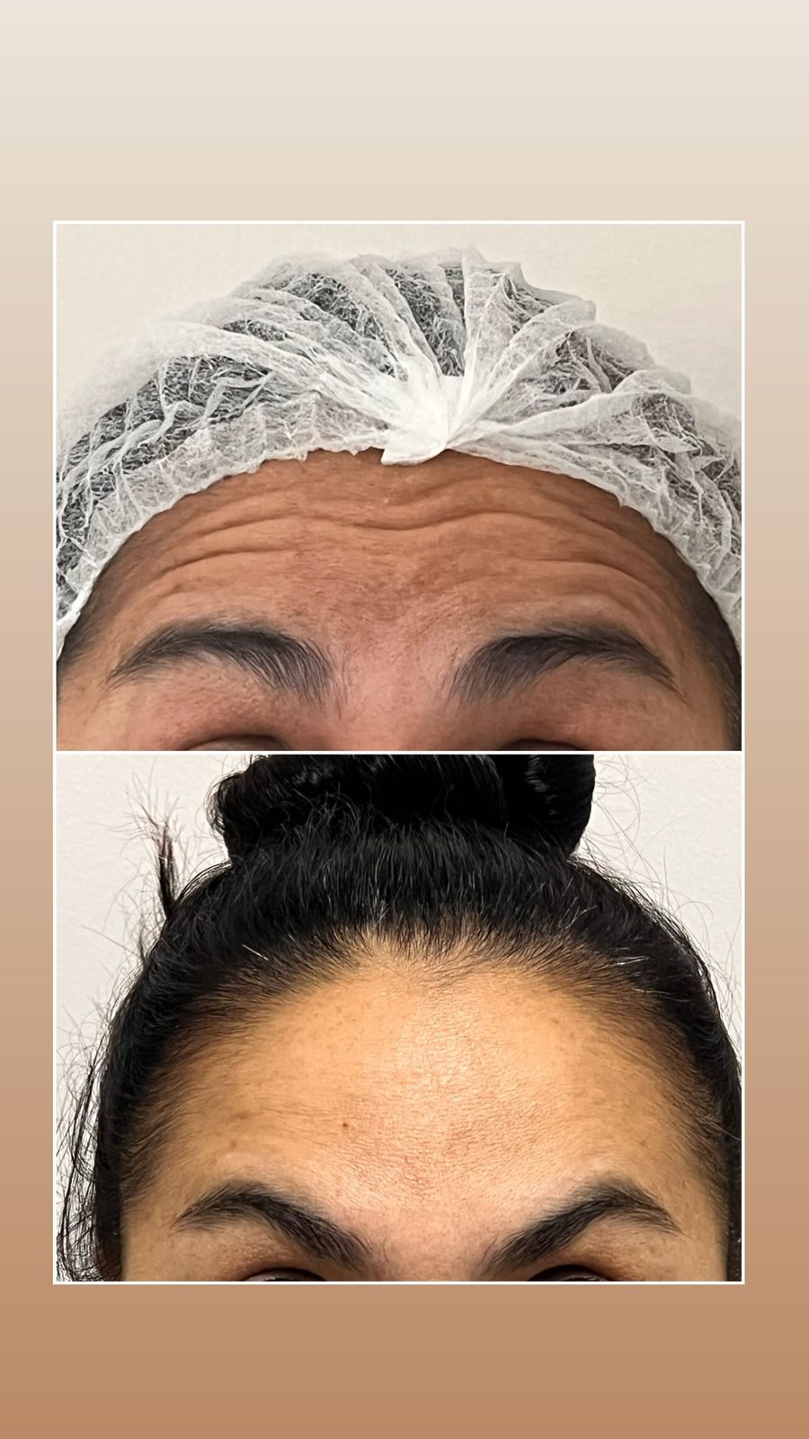 Antes e depois de toxina botulínica na testa