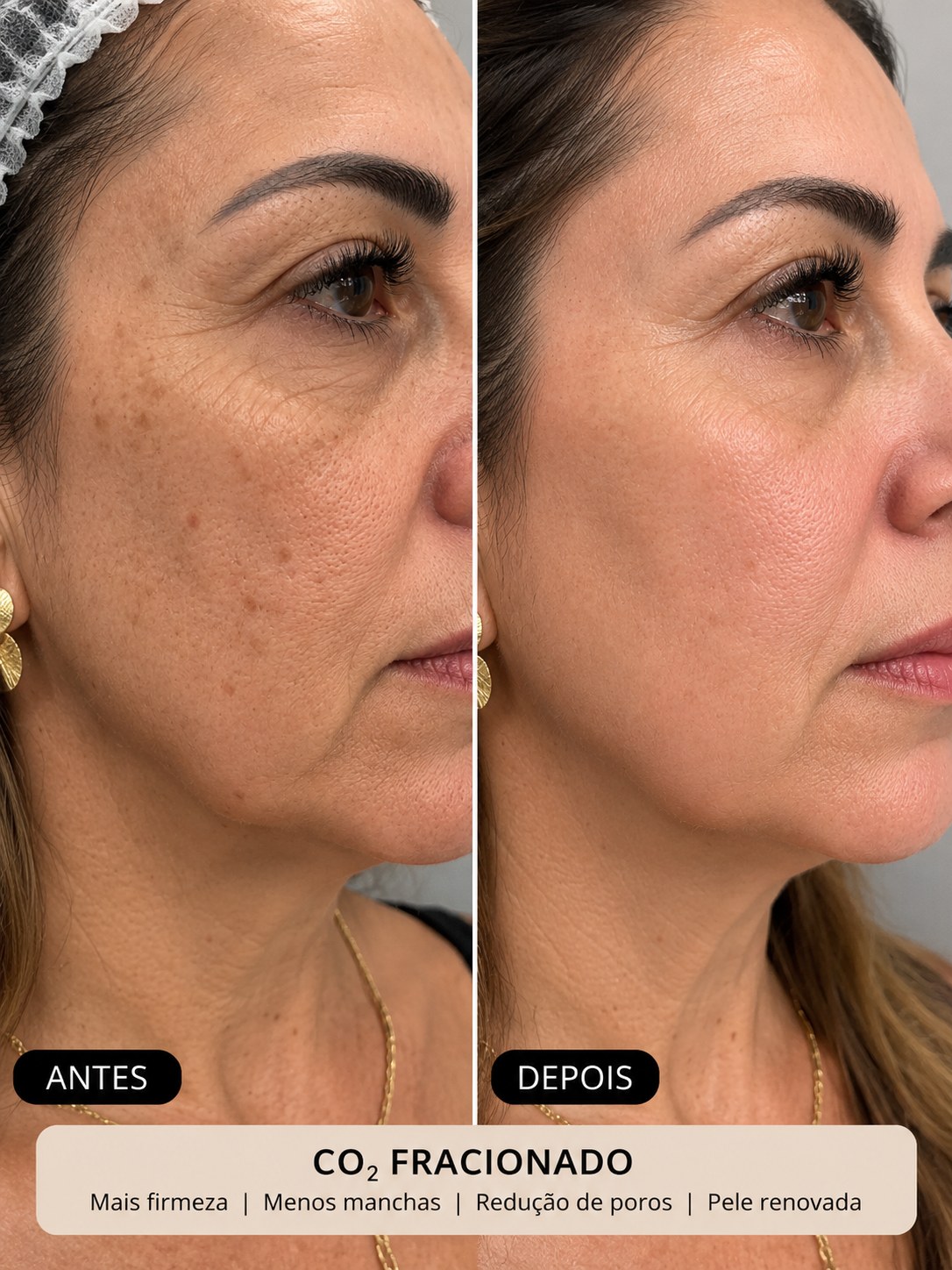 Antes e depois de CO2 fracionado no rosto