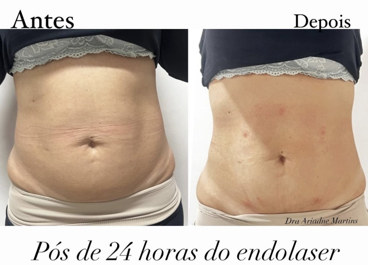 Antes e depois de endolaser no abdômen