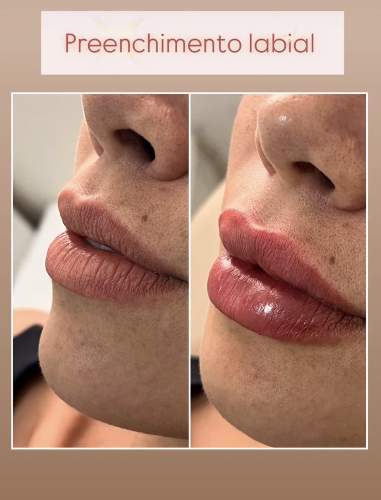 Antes e depois de preenchimento labial