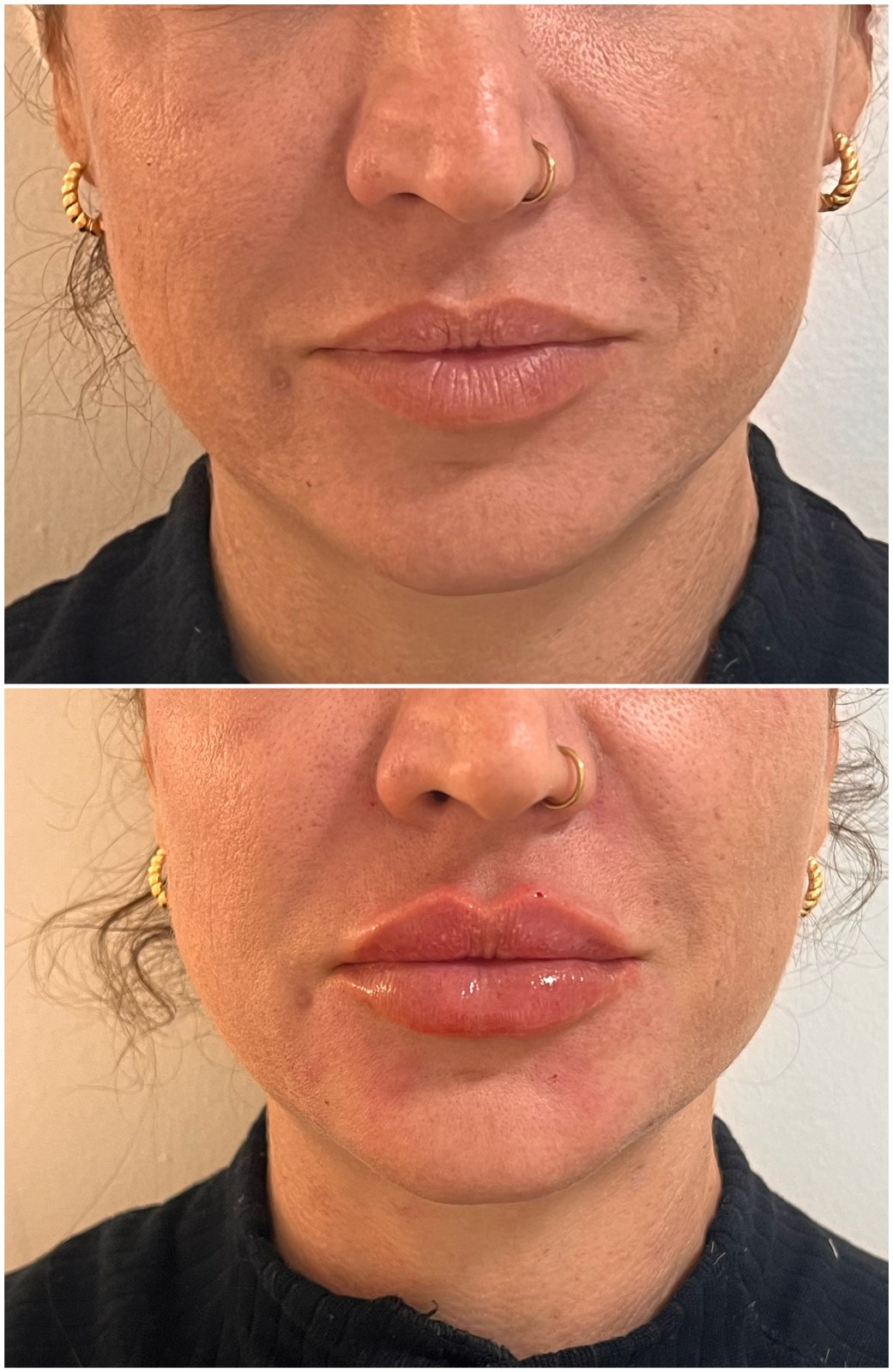 Antes e depois de preenchimento labial, rosto inteiro
