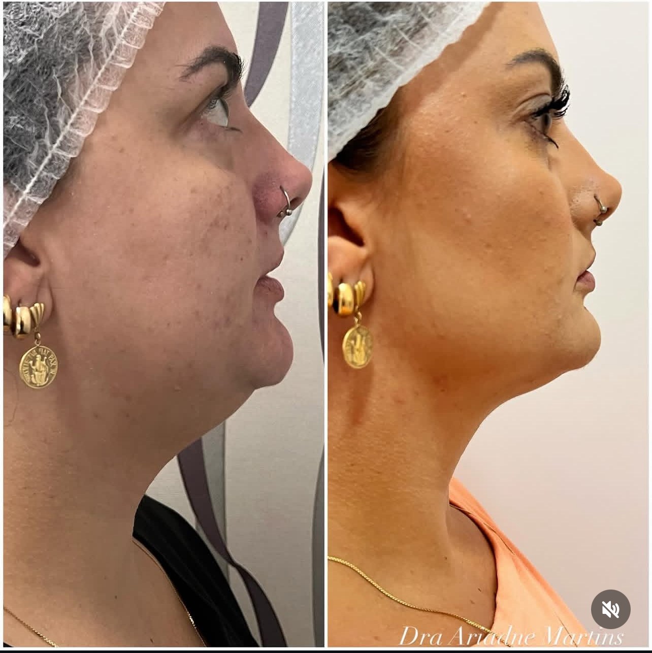 Antes e depois de harmonização facial e endolaser na papada
